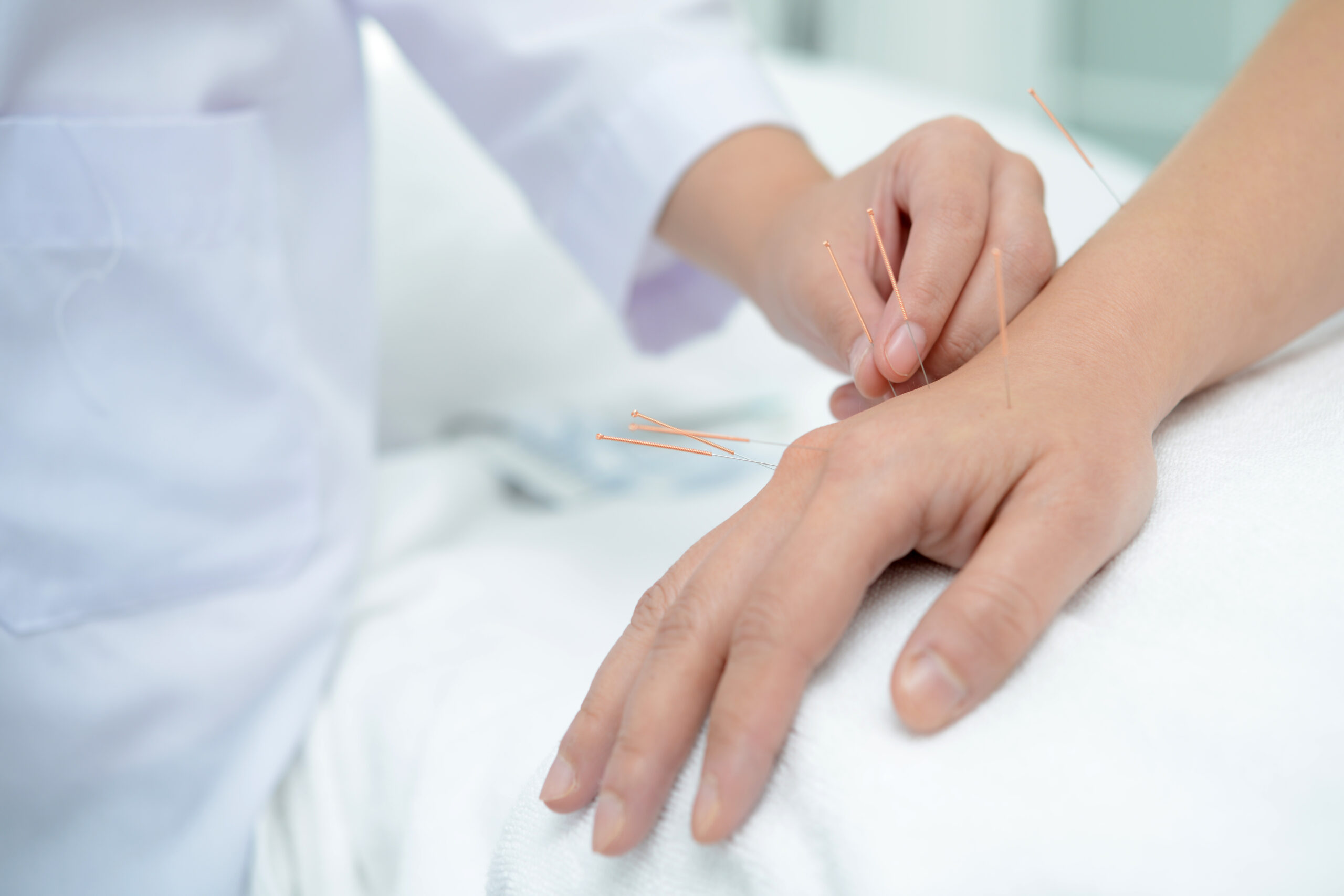 Artrite reumatoide e acupuntura: terapia complementar